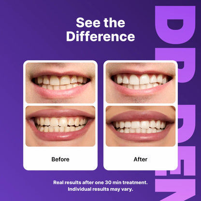 DRDENT Purple Teeth Whitening Strips - 7/21 Sessions - Gentle, Peroxide-Free Formula for Sensitive Teeth